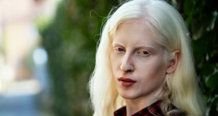 Albino Hastalığı