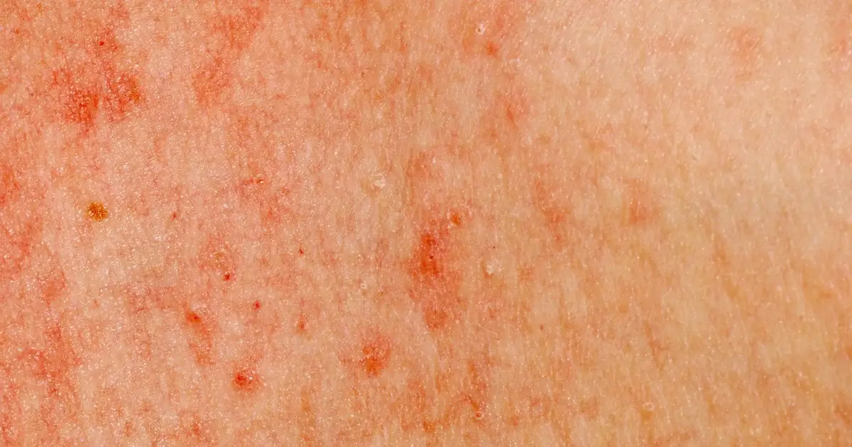 Alerjik dermatit