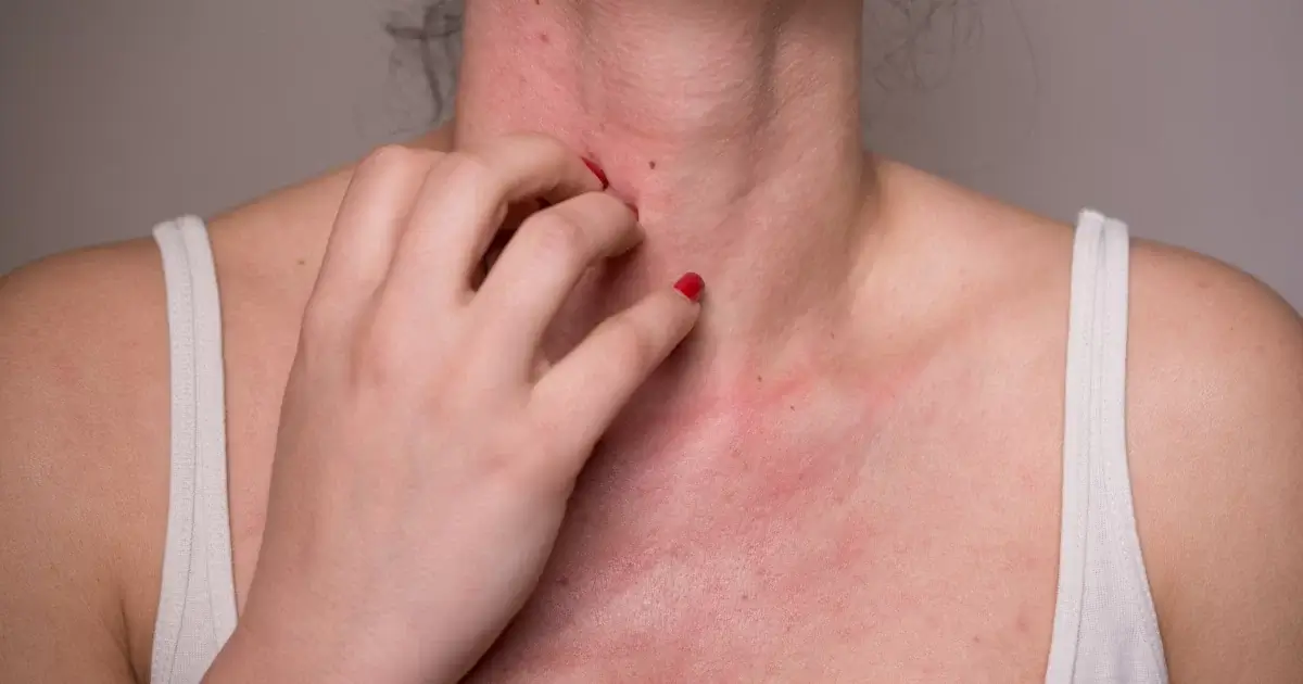 Besin alerjisi hangi yaşlarda görülür