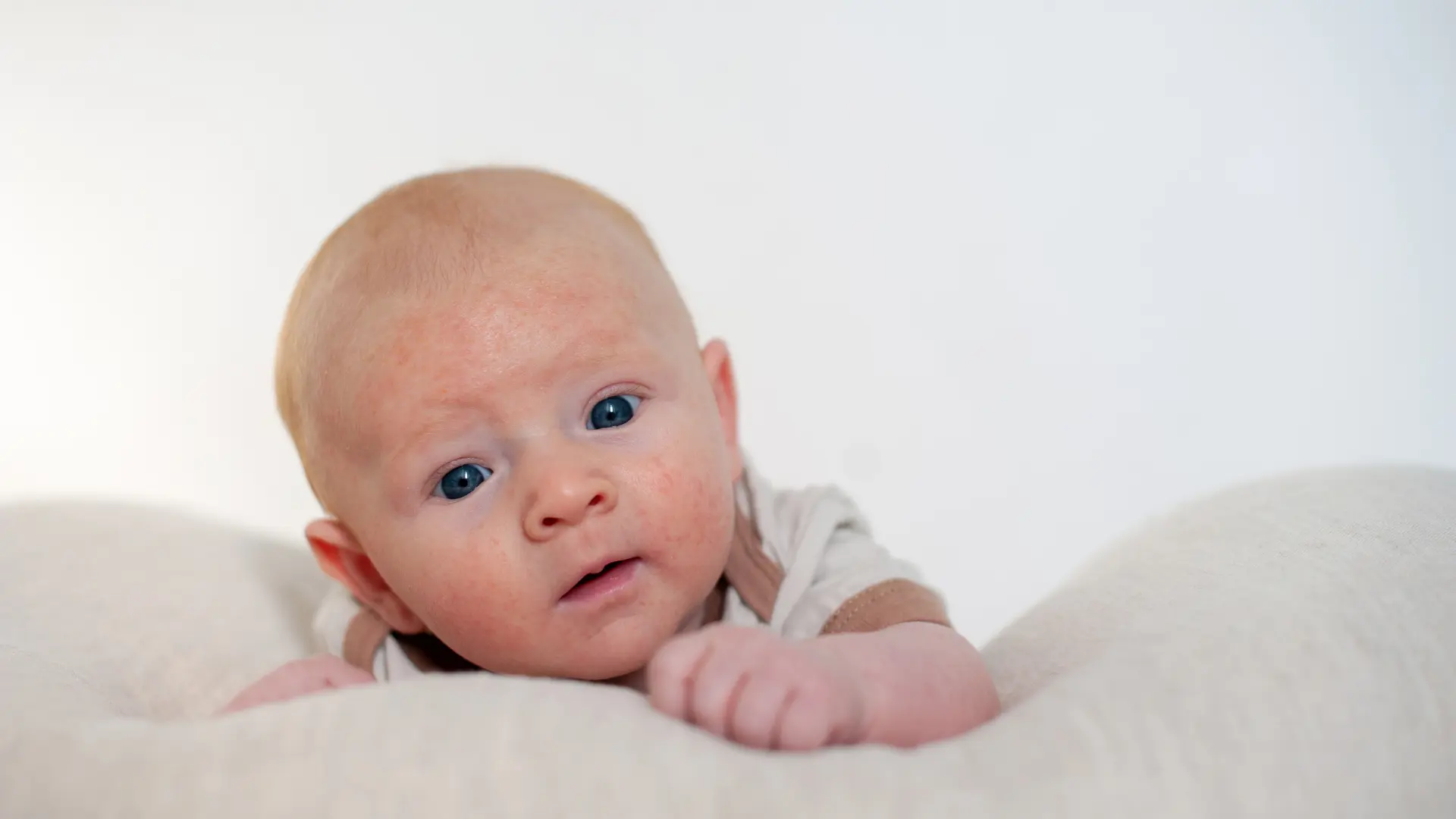 Bebeklerde Besin Alerjisi Belirtileri