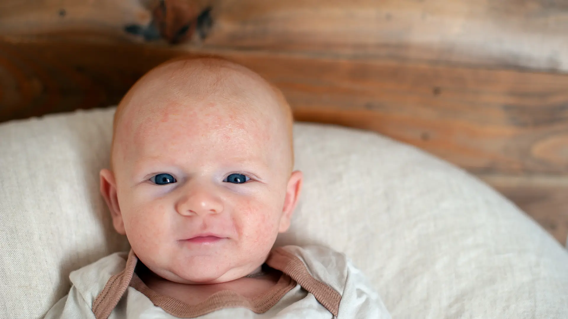 Bebeklerde En Çok Ne Alerji Yapar?